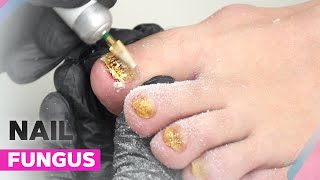 Onychomycosis  How to Deal with Nail Fungus [upl. by Evoy]