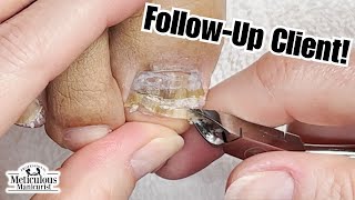 Best Toenail Cleaning on YouTube nails satisfying [upl. by Groves125]