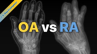 Osteoarthritis OA vs Rheumatoid Arthritis RA Explained  XRay Examples [upl. by Herbert]