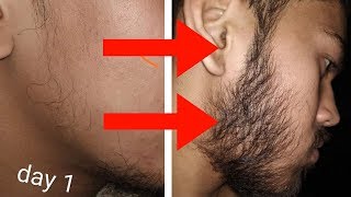 The REAL Patchy Beard Fix Proof given by my own Subscriber  Only the truth HINDI [upl. by Heather]