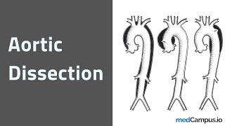 Aortic Dissection  Classification  Management  NEET PG  USMLE [upl. by Vilhelmina]