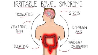 Irritable Bowel Syndrome IBS  Including Symptoms Criteria amp Treatment [upl. by Ytsur229]