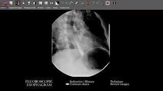 FL Esophagram  Search Pattern [upl. by Avraham]