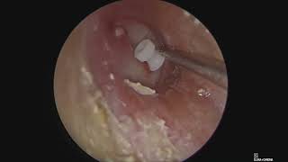 Endoscopic Myringotomy with Grommet insertion [upl. by Riada]