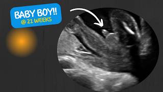 Baby boy21 weeks with cord around its neck  ultrasound [upl. by Linda]