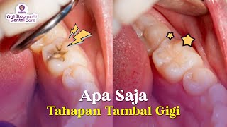 TAHAPAN DAN PROSES TAMBAL GIGI APA SAJA SIH [upl. by Drauode772]