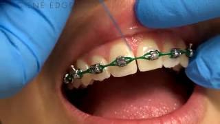 Flossing Braces With a Threader [upl. by Westney]