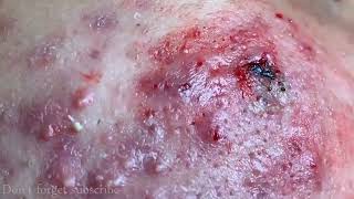 CYSTIC ACNE REMOVAL  Inflammatory Acne Acne Skin Treatment [upl. by Solomon84]