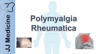 Polymyalgia Rheumatica  Signs amp Symptoms Diagnosis and Treatment [upl. by Adikram]