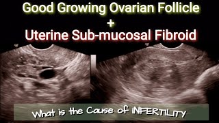 Ultrasound Good Ovarian Follicle at 9th Day  Uterine Submucosal Fibroid [upl. by Jadwiga]