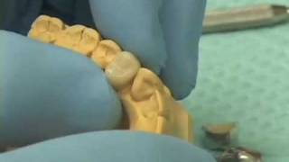 Fabricating Provisional Crowns [upl. by Letnahc]