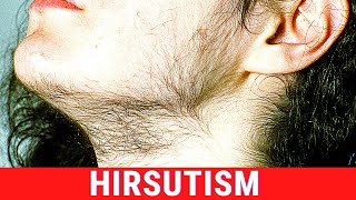 What is Hirsutism Symptoms Causes Treatment [upl. by Virgy]