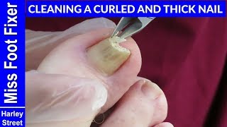 CUTTING AND CLEANING OF VERY HARD AND THICK TOENAIL BY MISS FOOT FIXER Marion Yau 向内生长的脚趾甲 [upl. by Otrebmal615]