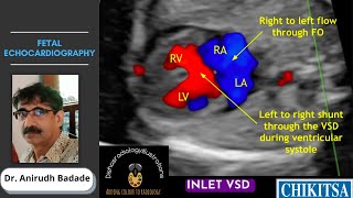 Fetal Echocardiography Basics Ultrasound  Dr Anirudh Badade [upl. by Eetnwahs162]