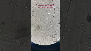 Trichomonas Vaginalis in Midstream Urine Sample [upl. by Alaek]