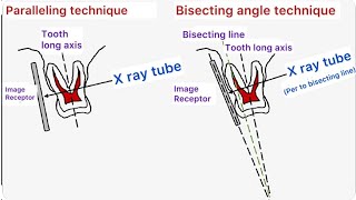 Dental Radiography Parallel angle vs Bisecting angle technique Basics  Part 1 [upl. by Twyla]