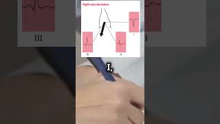 5 ECG for dummies THE SHAPE OF THE QRS COMPLEX [upl. by Fishbein734]