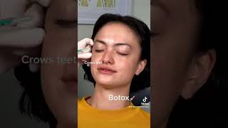 Botox  Where Can It Be Used [upl. by Angadreme]