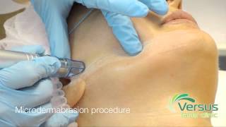 Microdermabrasion step by step demonstration [upl. by Terri]