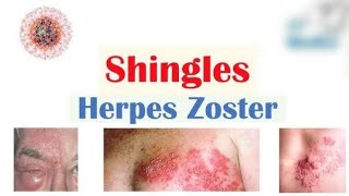 HERPES ZOSTERCAUSESSYMPTOMSMODE OF TRANSMISSIONTREATMENT [upl. by Janifer]