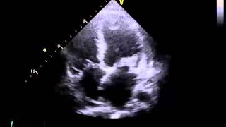 Echocardiography to Assess MitralValve Leaflets  NEJM [upl. by Iaras]