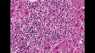 Histopathology LiverAcute myeloid leukemia [upl. by Eleahcim]