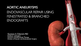 Aortic aneurysm treatment with endovascular fenestrated and branched stentgrafts [upl. by Blandina]