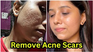 How to remove acne scars 😍  Acne scars remove treatment  My skin transformation journey [upl. by Marice509]