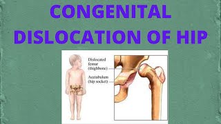 congenital dislocation of hip  PT ortho [upl. by Athal352]