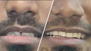 Teeth Gap Fast Closure in Chennai Before and After  Teeth Clip and Invisalign Procedure  DrMKP [upl. by Bertle282]