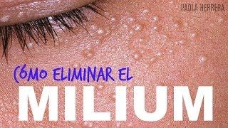 Granitos en los ojos CÓMO ELIMINAR EL MILIUM [upl. by Opiuuk]