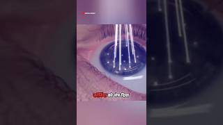 Shape of cornea by LASIK surgery life changing surgery science factbiology urcristiano climate [upl. by Osmond]