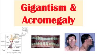 Gigantism amp Acromegaly  Growth Hormone Signs amp Symptoms Diagnosis Treatment [upl. by Iruj]