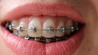 Braces time lapse  16 months [upl. by Porche]