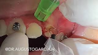 Gengivecotmia gengivoplastia com bisturi elétrico Gengivoplasty gengivectomy with Eletric bisturi [upl. by Etiuqal]