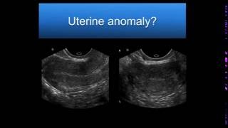 AIUM Webinar Problem Solving with 3D Sonography of the Uterus and Adnexa [upl. by Kelson]