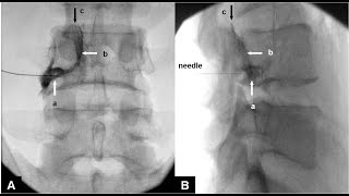 Fluoroscopic guided Lumbar epidural injection  Right L4 nerve root [upl. by Mayman]