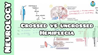 Crossed VS Uncrossed Hemiplegia  Neurology  USMLE NCLEX [upl. by Latsyrk20]