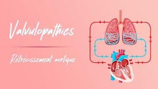 Rétrécissement aortique  Physiopathologie Signe cliniques [upl. by Nelleeus1]