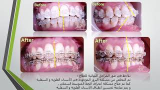 علاج بروز الأسنان العلوية و السفلية من خلال تقويم الأسنان Orthodontic treatment of teeth protrusion [upl. by Joanne]