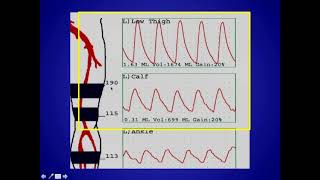 How to Perform and Interpret Peripheral Arterial Doppler Examinations [upl. by Sisi]