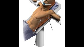 Hiperidrose  Cirurgia Simpatectomia [upl. by Schapira]