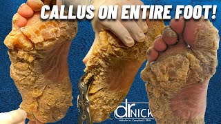 SHAVING CALLUS ON ENTIRE SOLE OF FOOT Dr Nick Campitelli Foot amp Ankle Surgeon [upl. by Leann404]