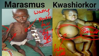 Protein Energy Malnutrition Biochemistry  Marasmus Vs Kwashiorkor  Kwashiorkor  Marasmus [upl. by Mandel]