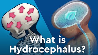 What is Hydrocephalus and Why Does Fluid Build Up in the Brain [upl. by Tenay567]