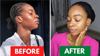 25 DAYS OF SKIN TRANSFORMATION USING TRETINOINHow Tretinoin saved my Skin Before amp After drpurity [upl. by Aneleiram]