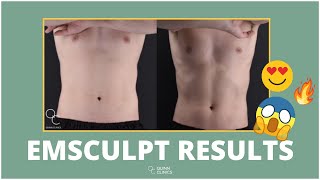 EMSCULPT  Before amp After’s   Is it WORTH it  amp Does it WORK  Quinn Clinics Bristol [upl. by Lekkim]