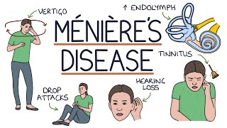 Understanding Ménière’s Disease [upl. by Belier]