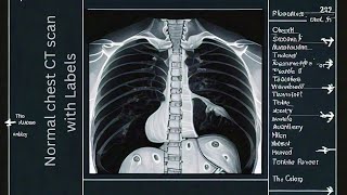 quotNormal Chest CT Scan Explained Detailed Anatomy with Labelsquot [upl. by Serafine]