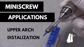 Miniscrew Applications Upper Arch DistalizationEssential Biomechanics [upl. by Nyrol]